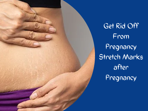 How To Get Rid Off From Stretch Marks After Pregnancy